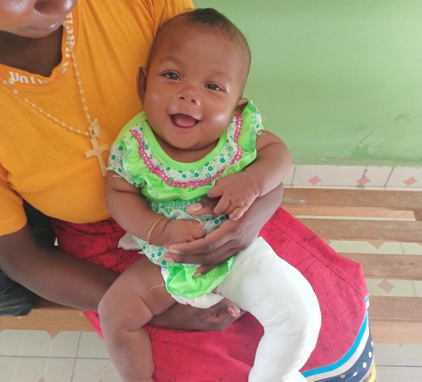 World clubfoot day 3 june australian doctors for africa